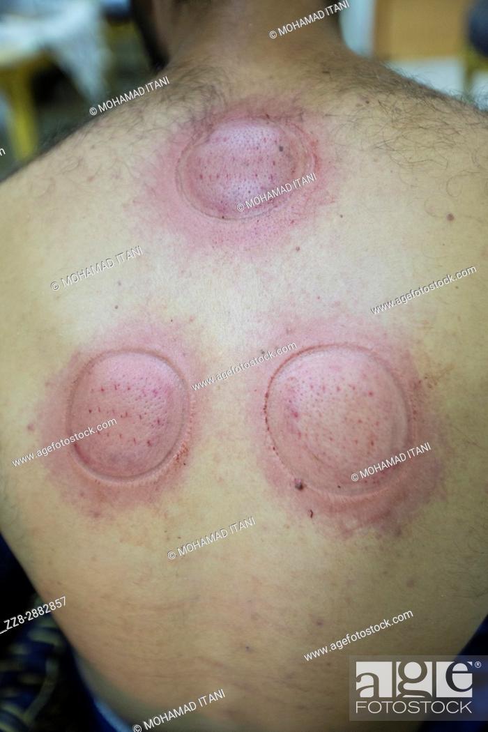 Stock Photo: Details of a man getting cupping done with a therapist.