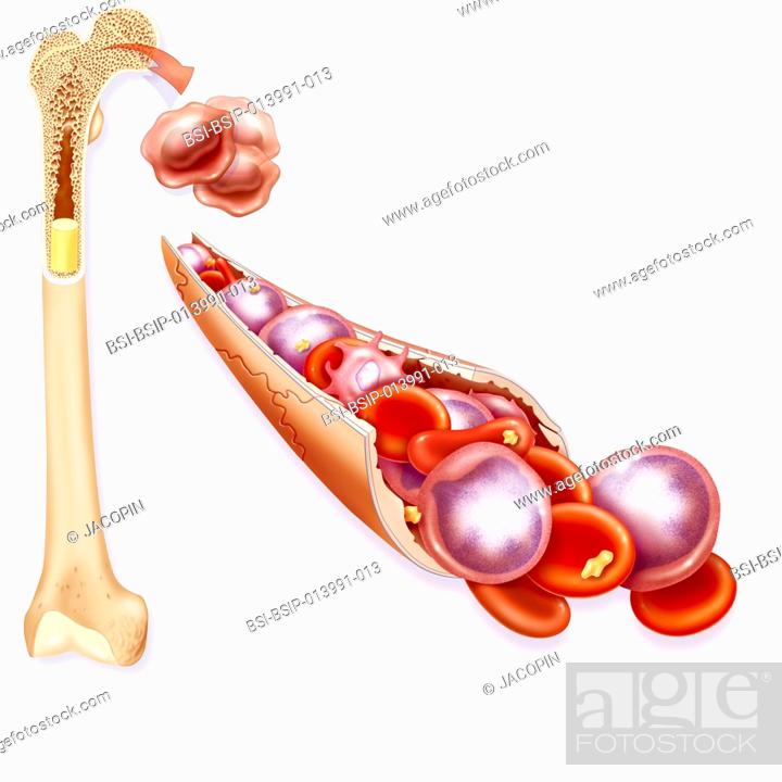 Illustration of leukemia. This pathology is a cancer of the bone marrow  cells, Stock Photo, Picture And Rights Managed Image. Pic.  BSI-BSIP-013991-013 | agefotostock