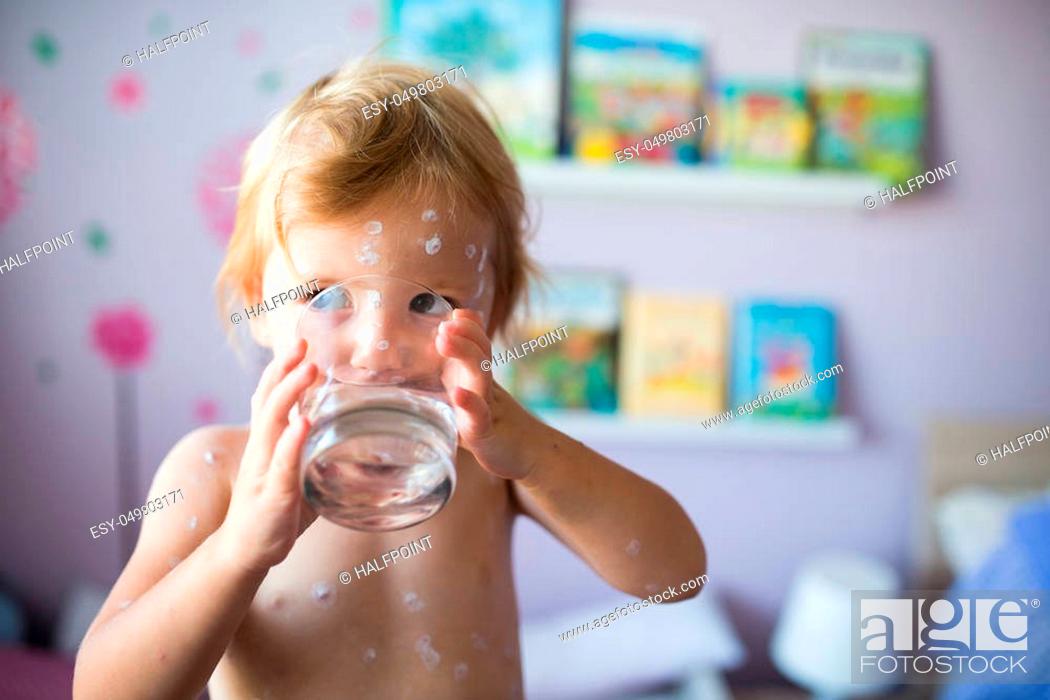 Stock Photo: Little two year old girl at home sick with chickenpox, white antiseptic cream applied to the rash. Holding a glass, drinking water.
