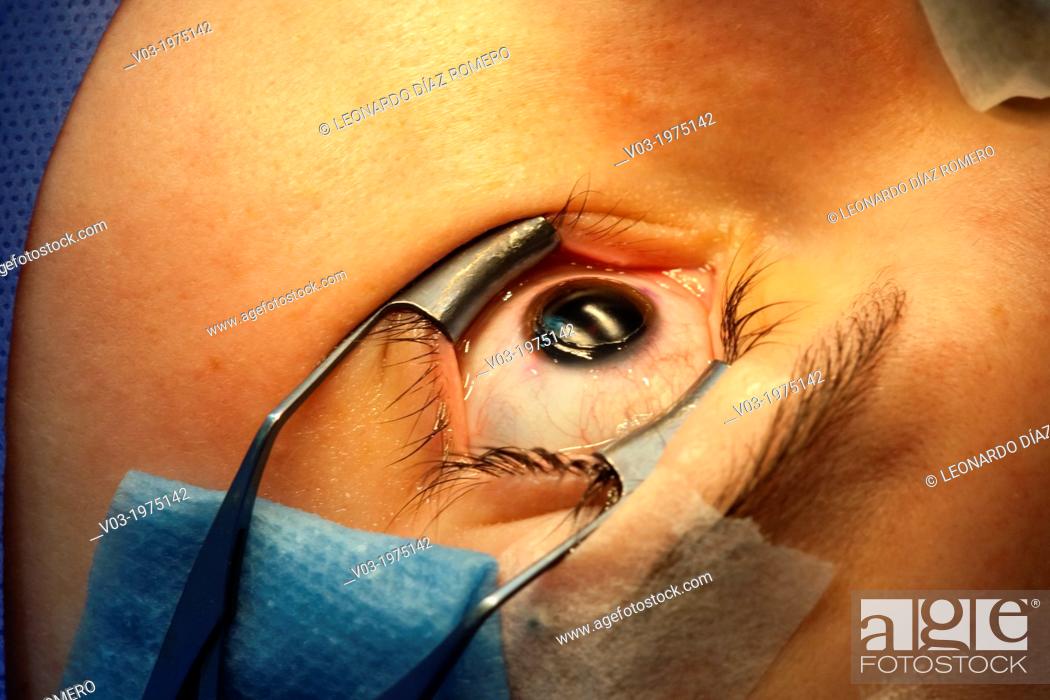 Imagen: Corrective Eye Surgery.