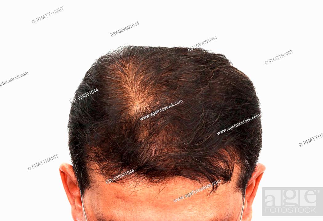 Male head with hair loss symptoms front side, Stock Photo, Picture And Low  Budget Royalty Free Image. Pic. ESY-039001044 | agefotostock