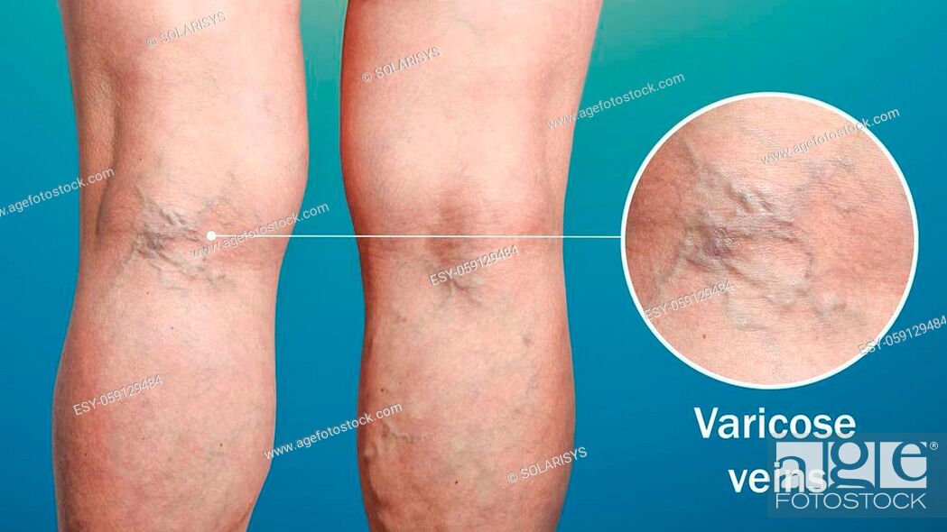 Stock Photo: The old age and sick of a woman. Varicose veins on a legs of woman. The varicosity, spider veins, edema, illness concept.