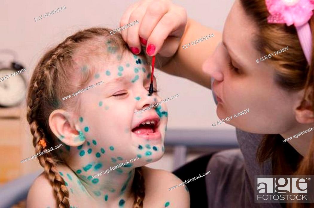Stock Photo: Mom misses zelenkoj sores in a child with chickenpox.