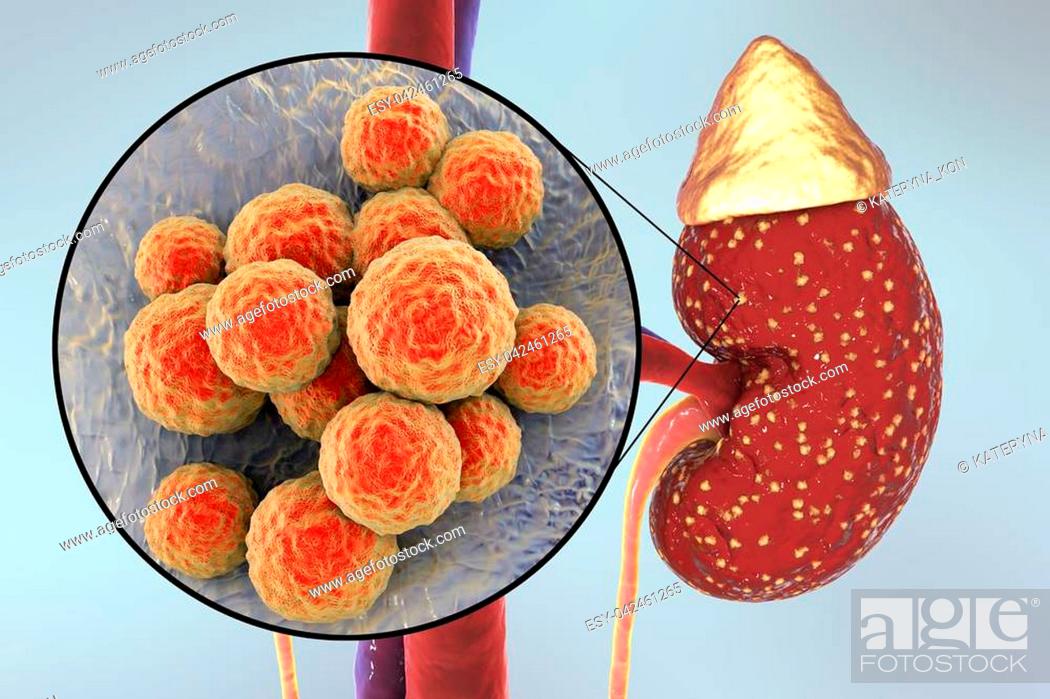 Stock Photo: Pyelonephritis, medical concept, and close-up view of bacteria Staphylococcus, the common causative agent of kidney infection, 3D illustration.
