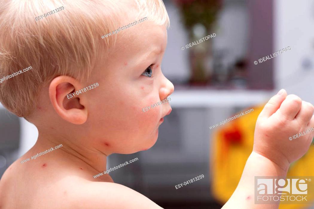 Stock Photo: Portrait of cute toddler with chickenpox. Funny baby boy with varicella.