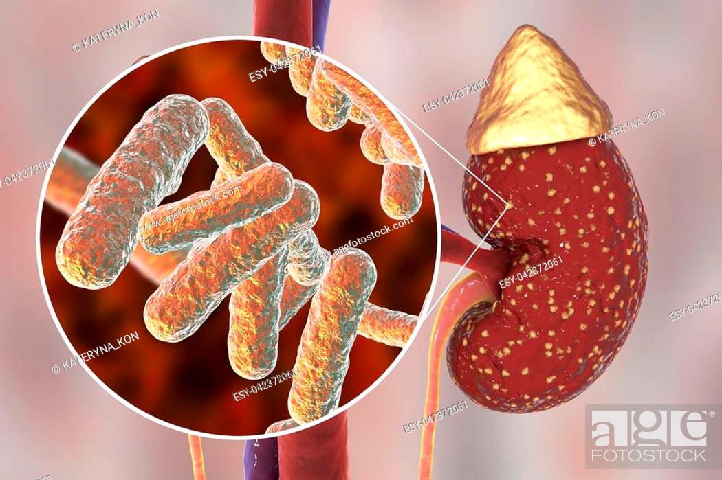 Stock Photo: Pyelonephritis, medical concept, and close-up view of bacteria, the common causative agent of kidney infection, 3D illustration.