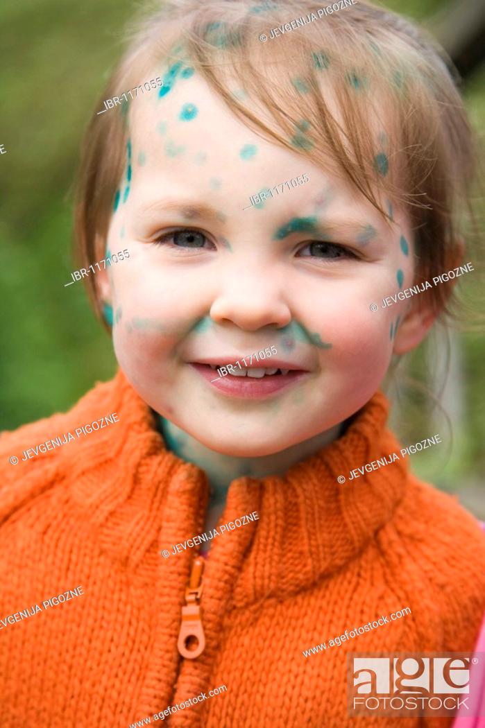 Stock Photo: Toddler girl with Chickenpox.