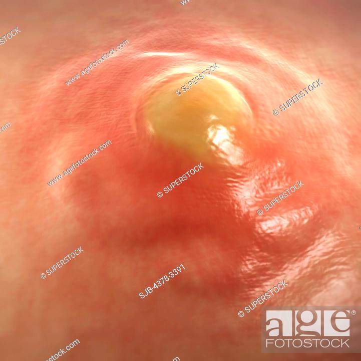 A boil or furuncle is a result of folliculitis which is a deep infection of  the hair follicle, Stock Photo, Picture And Rights Managed Image. Pic.  SJB-4378-3391 | agefotostock
