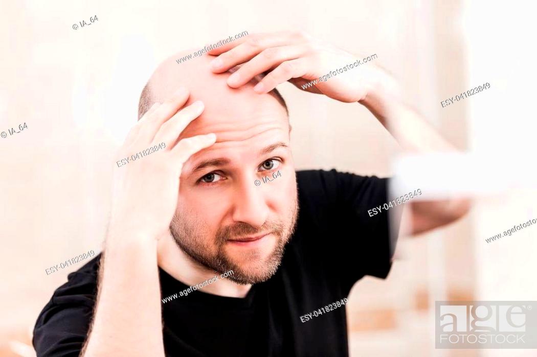 Stock Photo: Male alopecia or hair loss concept - adult caucasian bald man looking mirror for head baldness treatment.