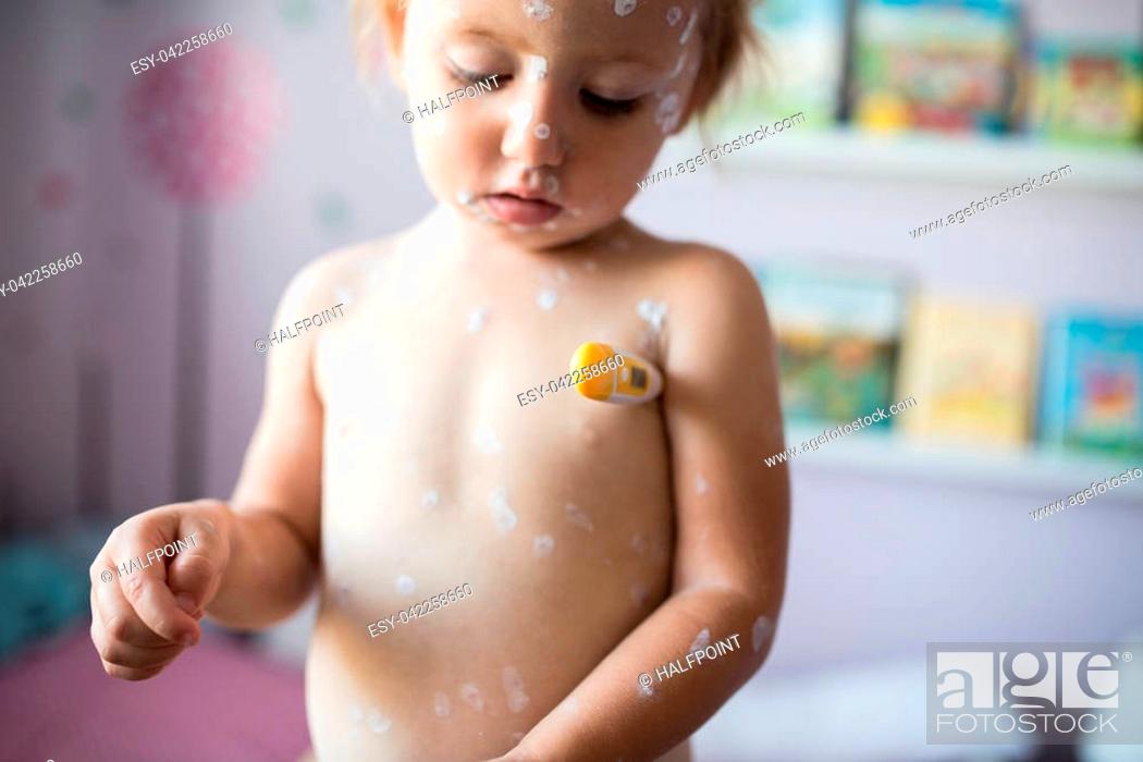 Stock Photo: Little two year old girl at home sick with chickenpox, white antiseptic cream applied to the rash, measures the temperature with thermometer under her arm.
