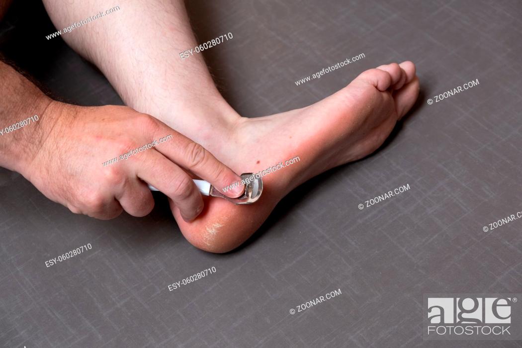 Stock Photo: Man removing corn, callus from his feet using a razor file, masculine skin care, skin disease, fungal infection, skin treatment and healthcare, close up.