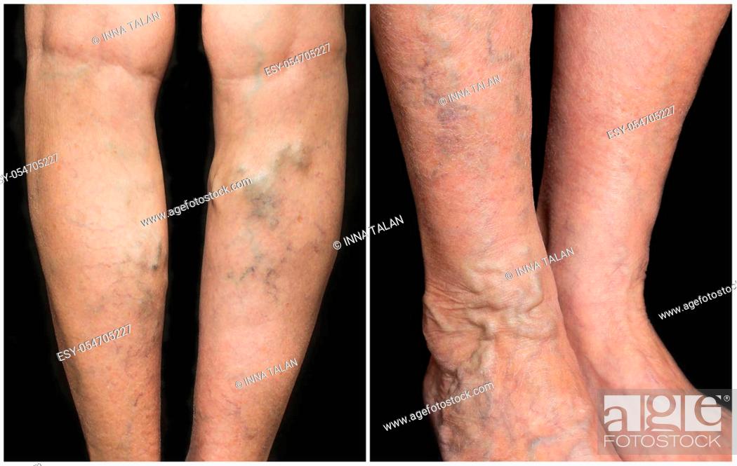 Stock Photo: The varicose veins on a legs of old woman on gray.