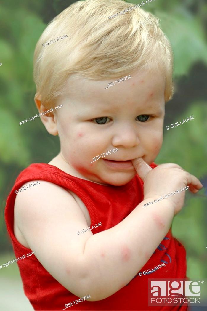 Stock Photo: CHICKENPOX<BR>Model.<BR>Boy with chicken pox.