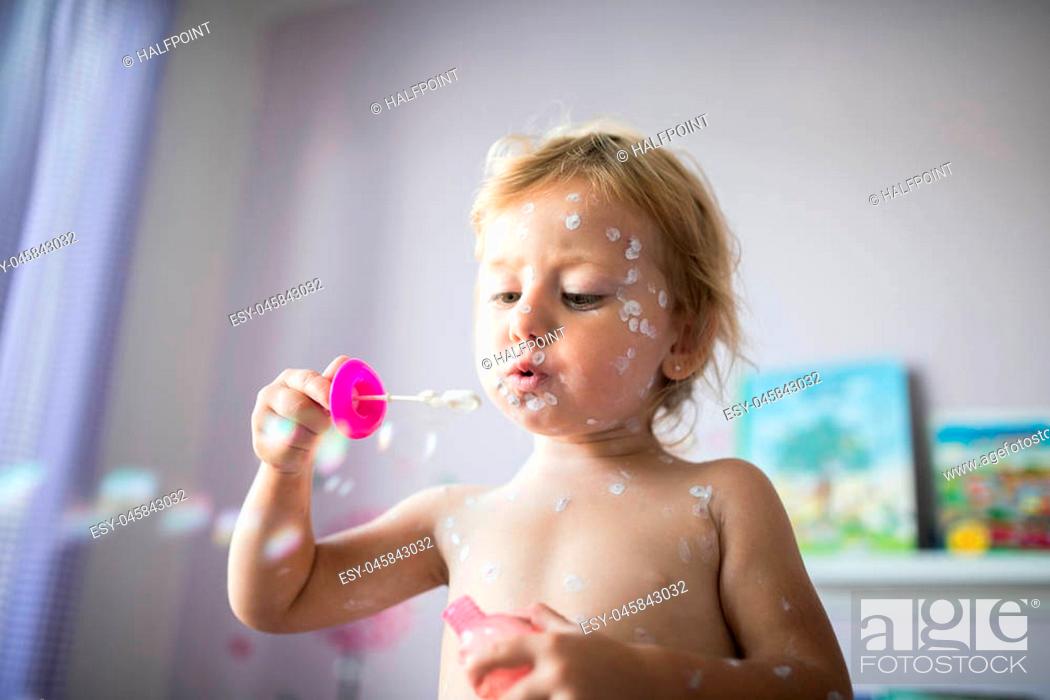 Stock Photo: Little two year old girl at home sick with chickenpox, white antiseptic cream applied to the rash.