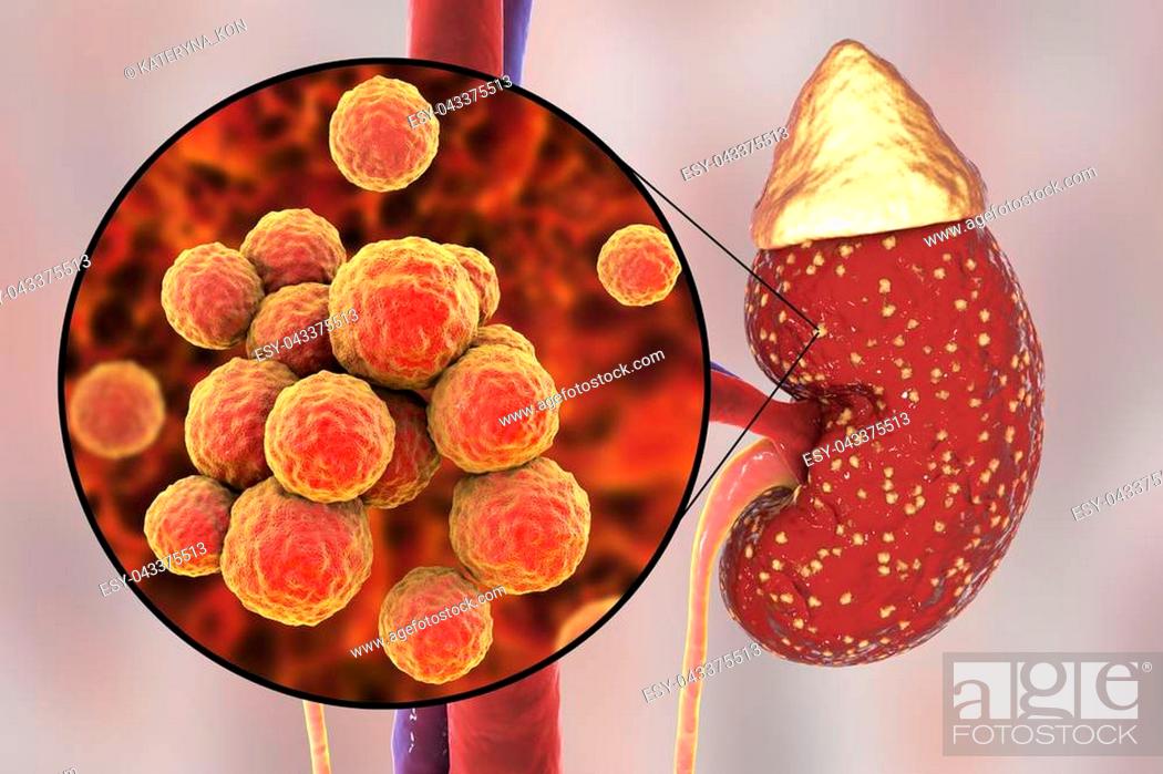 Stock Photo: Pyelonephritis, medical concept, and close-up view of bacteria Staphylococcus, the common causative agent of kidney infection, 3D illustration.