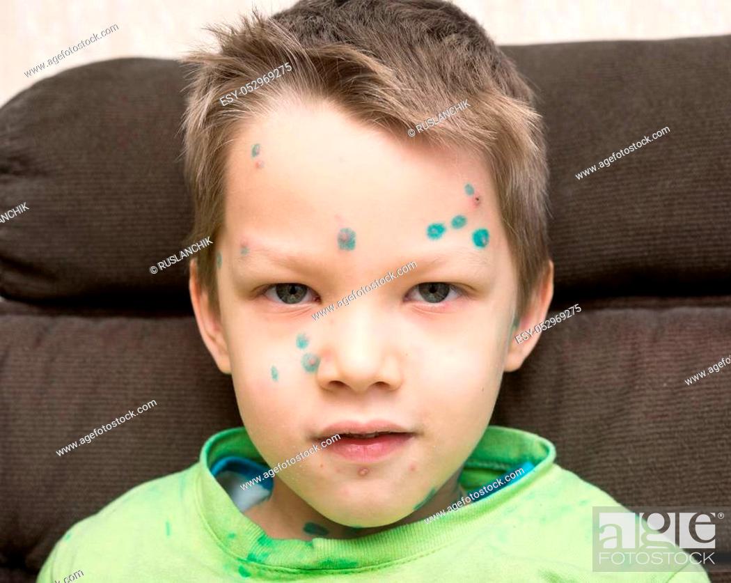 Stock Photo: Young boy with chicken pox.