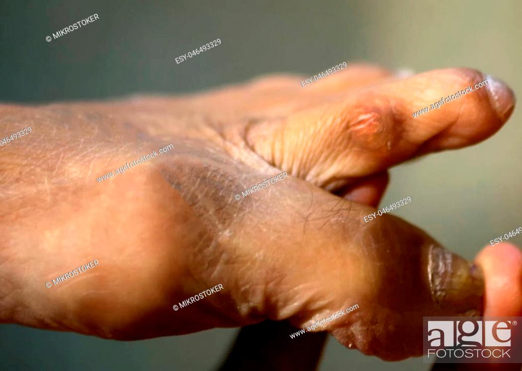 Stock Photo: Corn between fingers on the foot. Rubbing on the second toe. Corns on the foot.