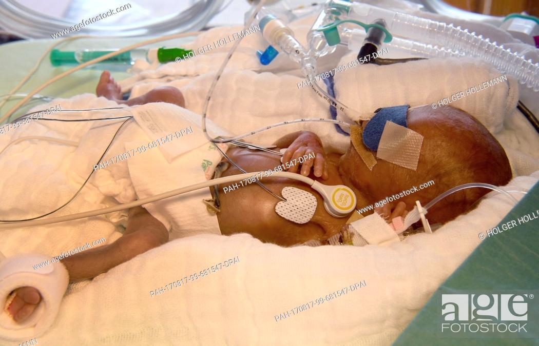 Stock Photo: A 5-day-old boy who weighed 430 grams at birth, in an incubator at the children's clinic of Hannover Medical School (Medizinische Hochschule Hannover.