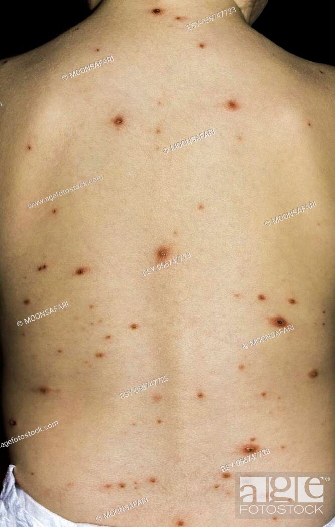 Stock Photo: Varicella Virus or Chicken Pox on Babys Back.