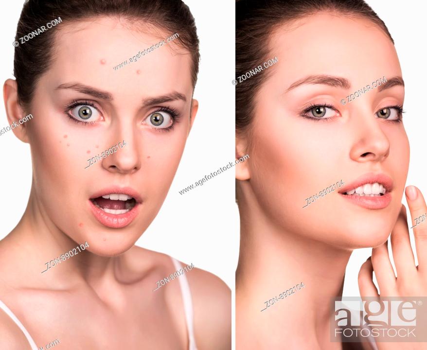 Stock Photo: Comparative photos of young woman with skin problems. Before and after treatment.