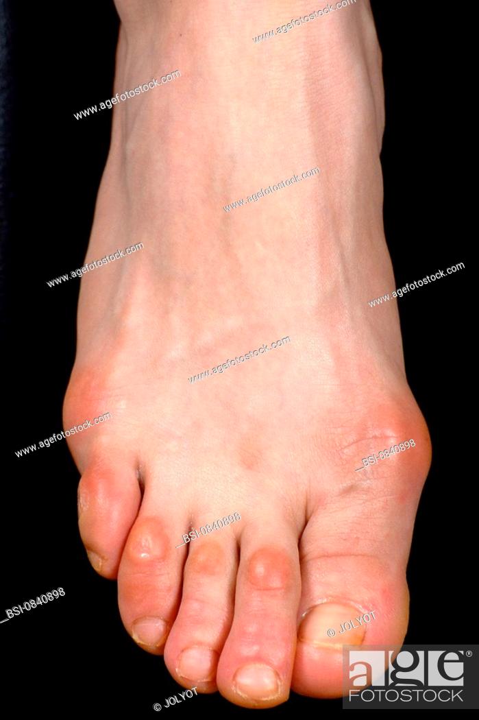 Stock Photo: FOOT WITH A CORN<BR>Corns on the top side of foot.