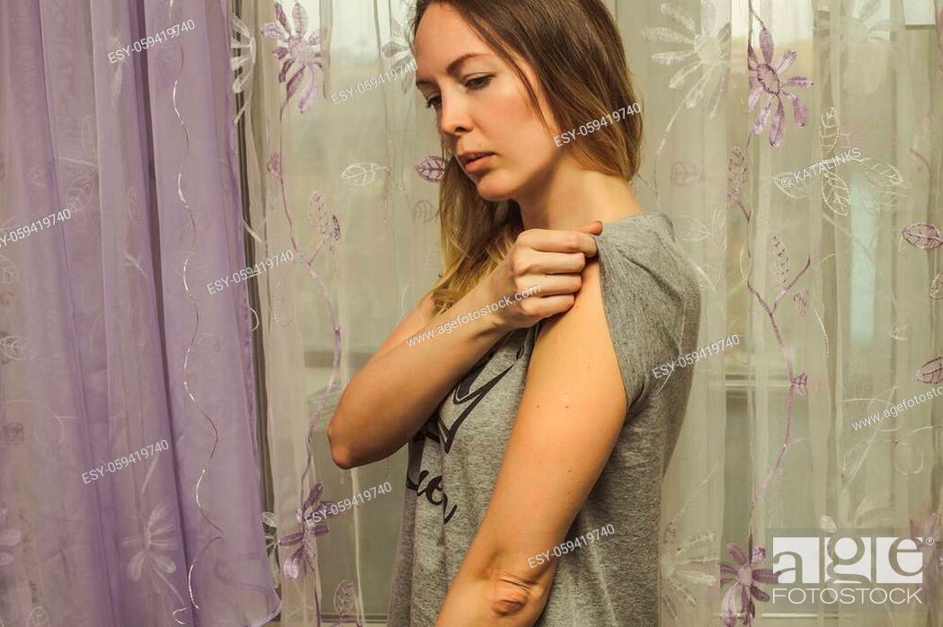 Stock Photo: Woman with smallpox following BCG vaccination against TB vaccine on her arm.