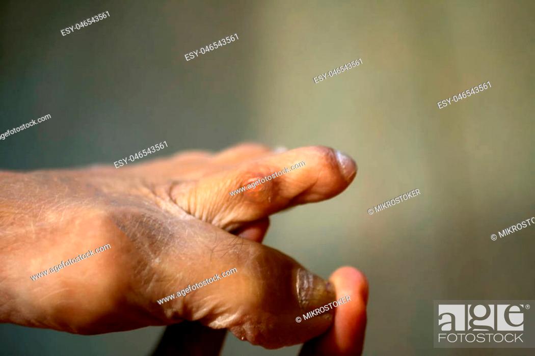 Photo de stock: Corn between fingers on the foot. Rubbing on the second toe. Corns on the foot.