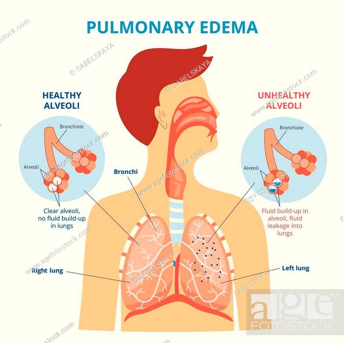 Pulmonary edema - respiratory lung disease infographic with flat cartoon  man drawing showing his..., Stock Vector, Vector And Low Budget Royalty  Free Image. Pic. ESY-057087375 | agefotostock