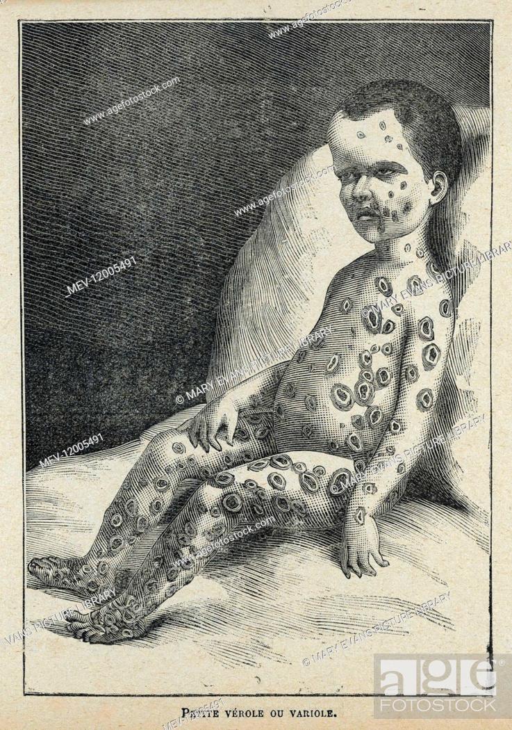 Stock Photo: Child with smallpox.