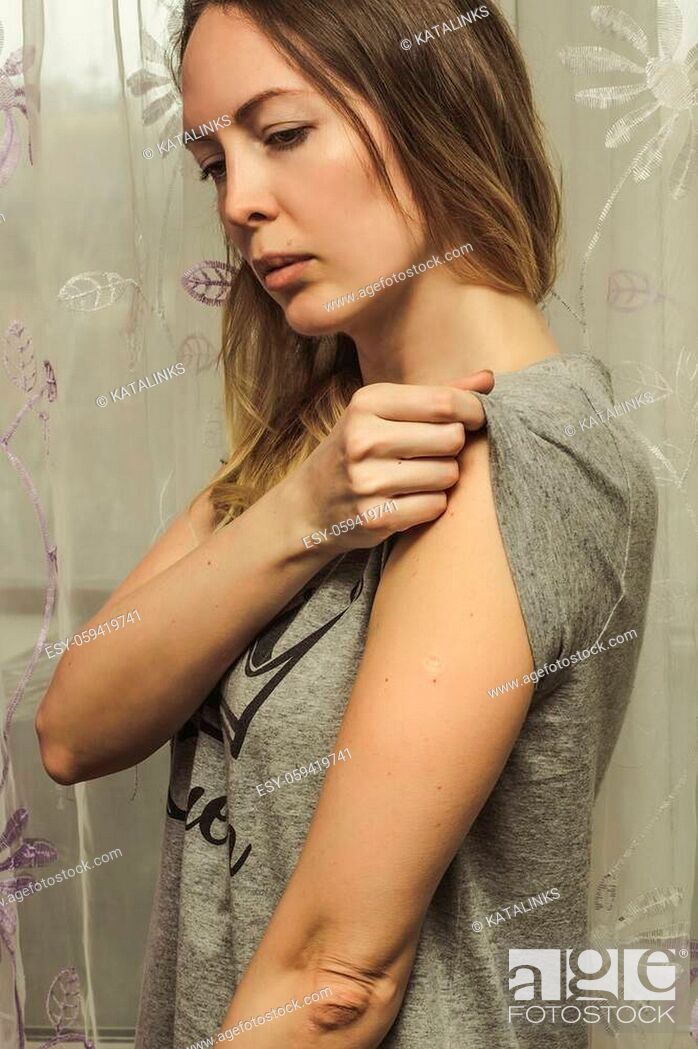 Stock Photo: Woman with smallpox following BCG vaccination against TB vaccine on her arm.