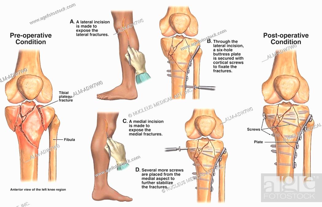 Fractured Tibial Plateau And Femur - Only Creative Stock Images, Photos &am...