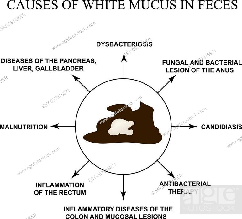 White Mucus In Diseases, White Mucus In Stool