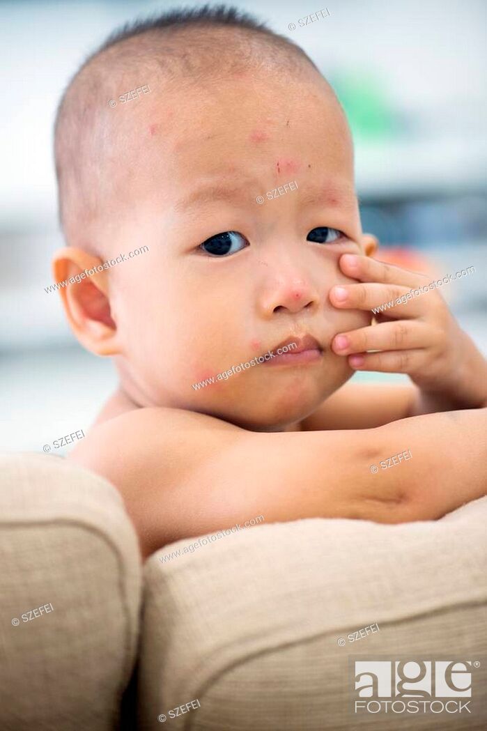 Stock Photo: Asian baby sitting on couch with chicken pox rash, natural photo.