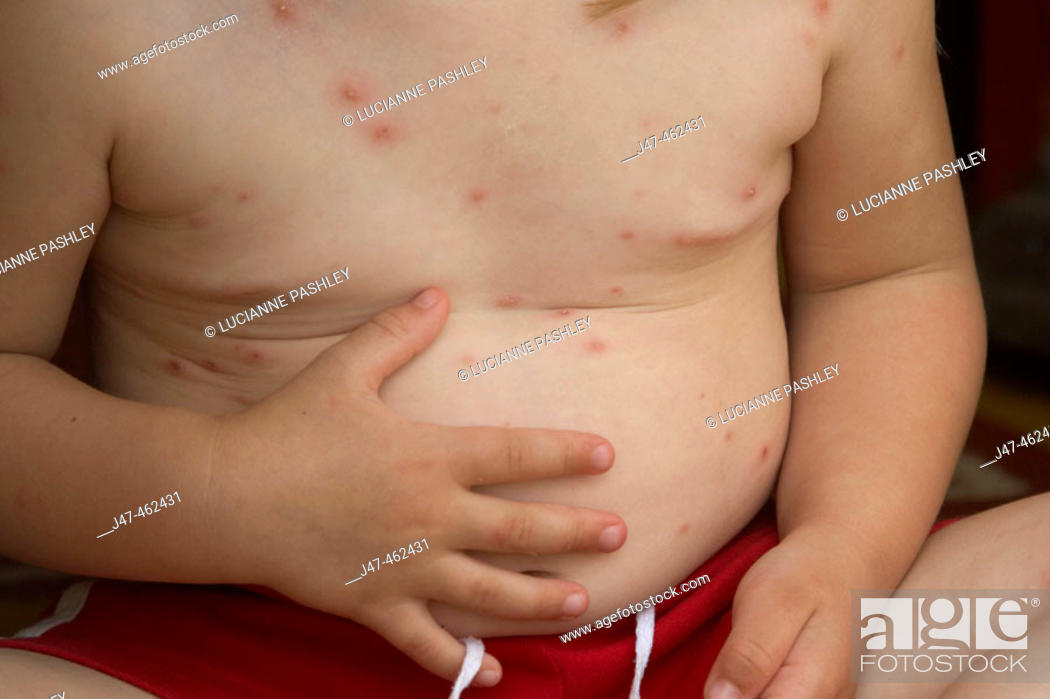 Stock Photo: 1 year old boys tummy covered in chicken pox.