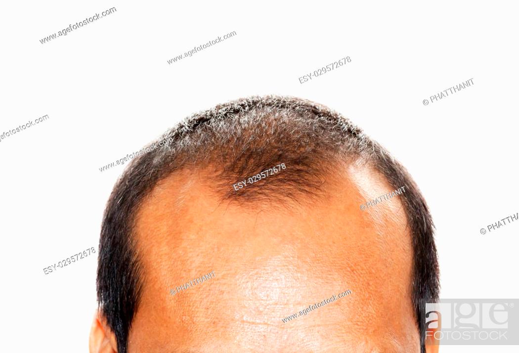 Male head with hair loss symptoms front side, Stock Photo, Picture And Low  Budget Royalty Free Image. Pic. ESY-029572678 | agefotostock