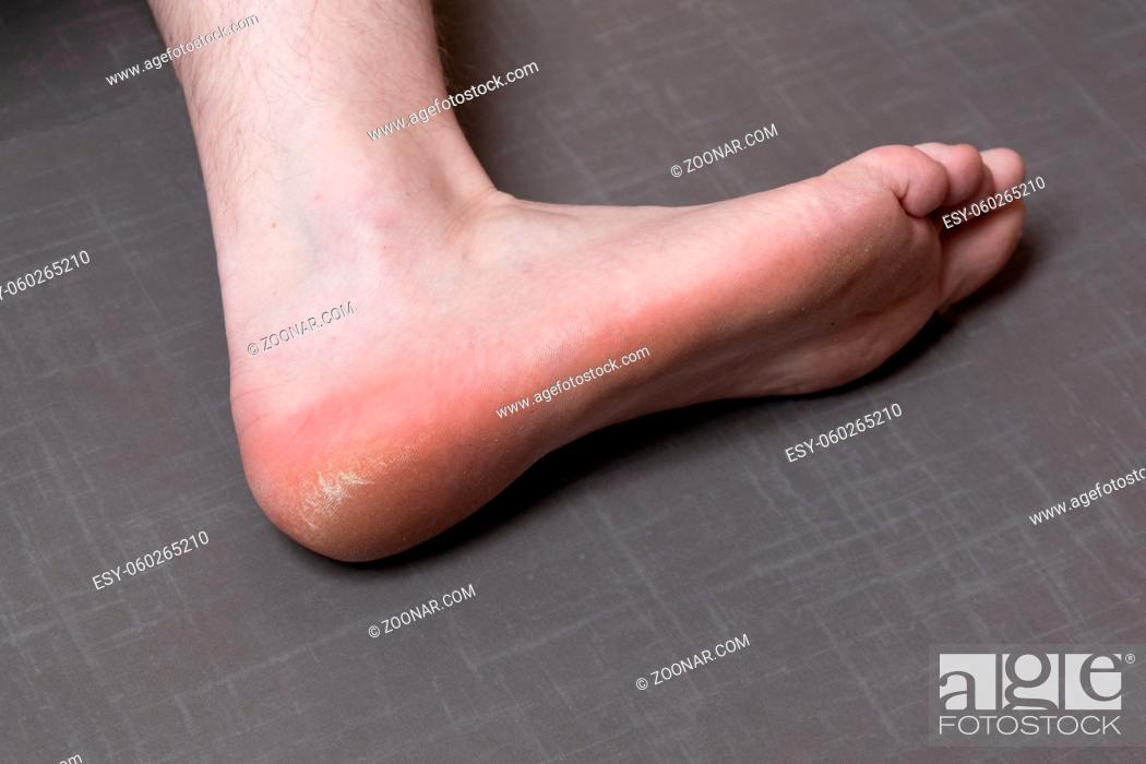 Stock Photo: Close up of caucasian male dehydrated skin on the heels, trating callus, corn with scraper file, man removing corn, callus from his feet, masculine skin care.