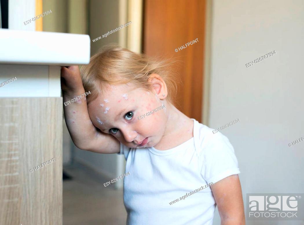 Stock Photo: Little two year old girl at home sick with chickenpox, white antiseptic cream applied to the rash.