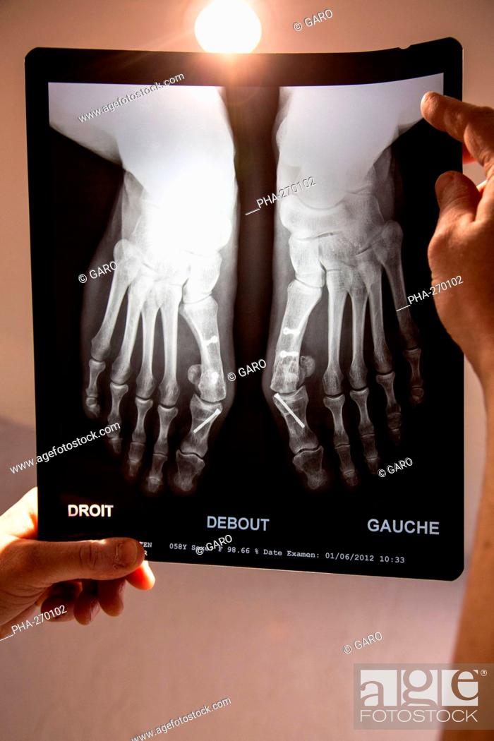 Stock Photo: X-ray of feet affected by bunion (hallux valgus) after surgical treatment.