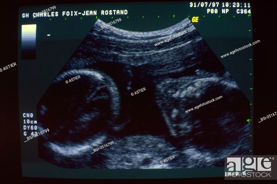 When do twins show up on ultrasound