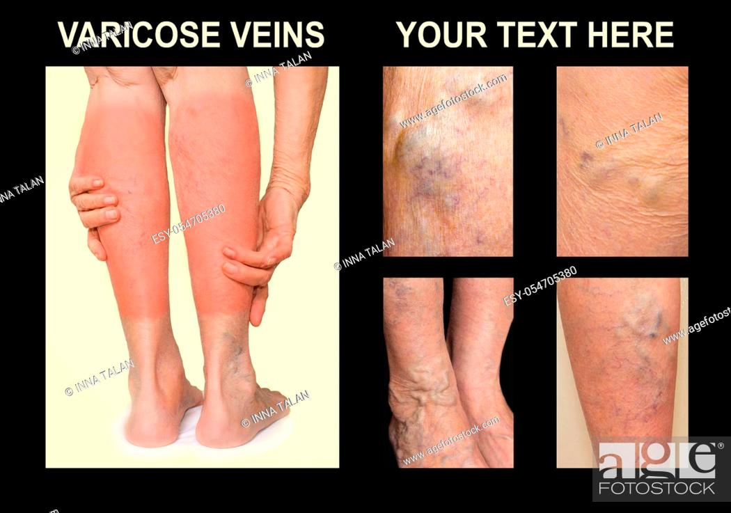 Stock Photo: Painful varicose veins, , spider veins, varices on a female leg. Ageing, old age disease, aesthetic problem concept. Collage.