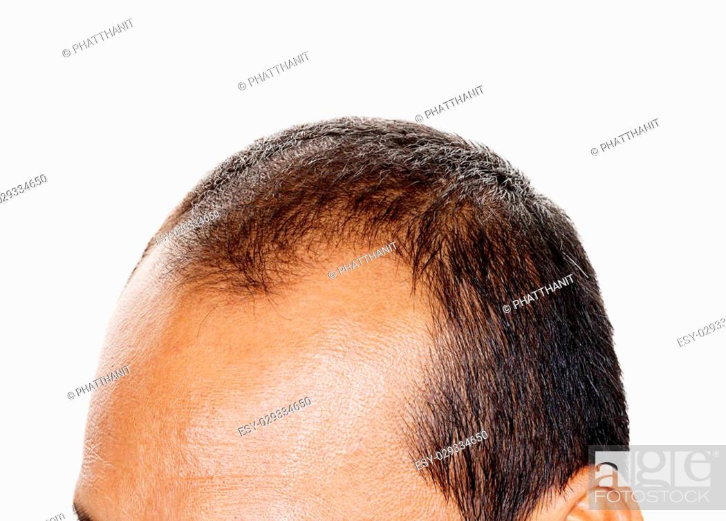 Hair loss , Male head with hair loss symptoms front side, Stock Photo,  Picture And Low Budget Royalty Free Image. Pic. ESY-029334650 | agefotostock