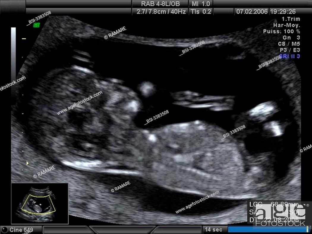 Ultrasound at 13 weeks