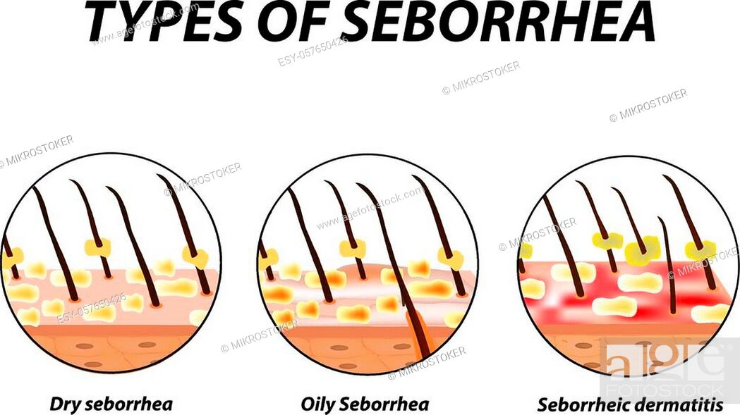 Types of seborrhea. Seborrhea skin and hair. Dandruff, seborrheic  dermatitis, Stock Vector, Vector And Low Budget Royalty Free Image. Pic.  ESY-057650426 | agefotostock