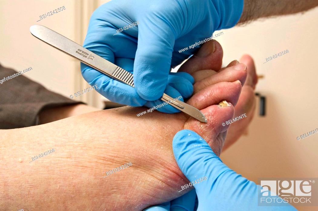 Stock Photo: Photo essay from hospital. Pedicure care at the Corentin Celton hospital Issy-les-Moulineaux, France on the corn of a diabetic patient's foot.